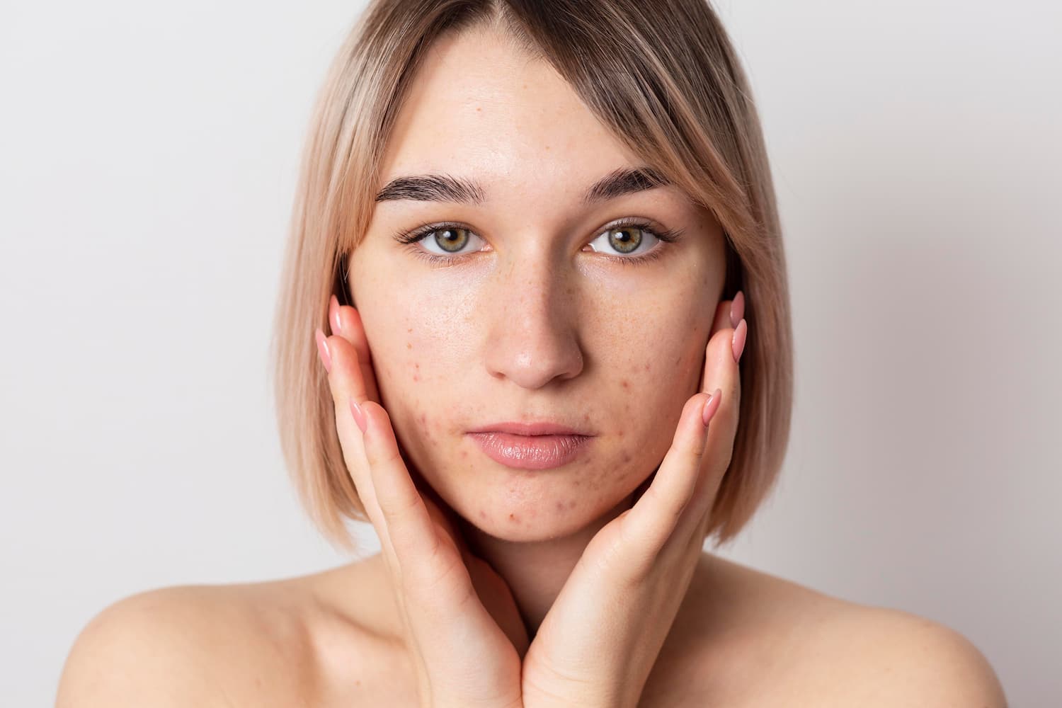 Benzoyl peroxide (Benzacne ingredient): what it is and how it works